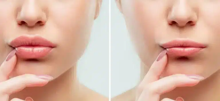 La technique d’injection d’acide hyaluronique pour des lèvres pulpeuses et naturelles: Russian Lips